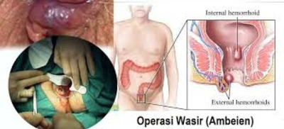 Jual Ambejoss Salep Salwa Obat Wasir De Nature Di Sabang