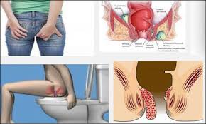 Jual Ambejoss Salep Salwa Obat Wasir De Nature Di Sikka