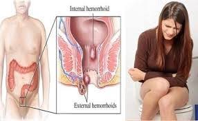 Jual Ambejoss Salep Salwa Obat Wasir De Nature Di Yahukimo